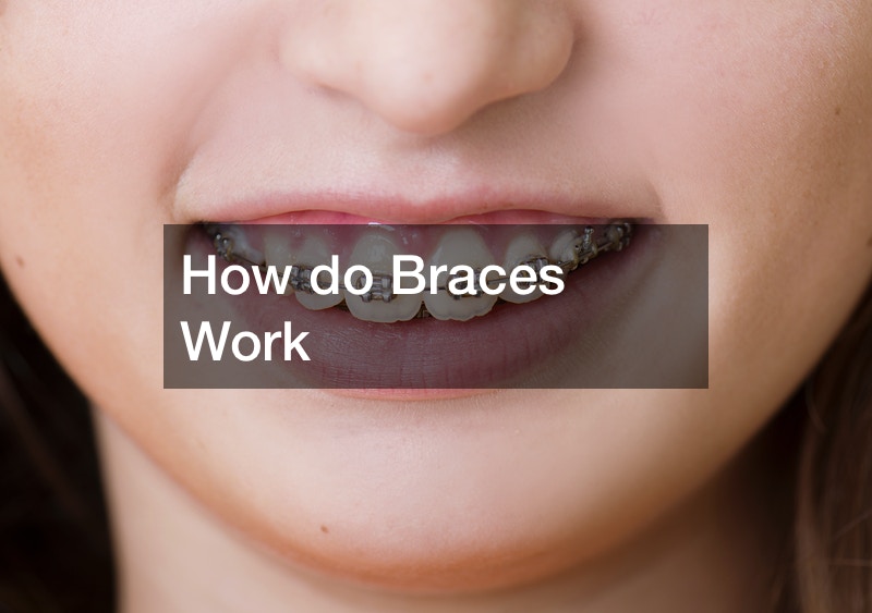 How do Braces Work