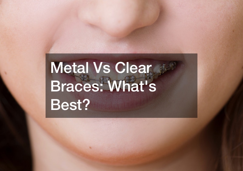 Metal Vs Clear Braces Whats Best?