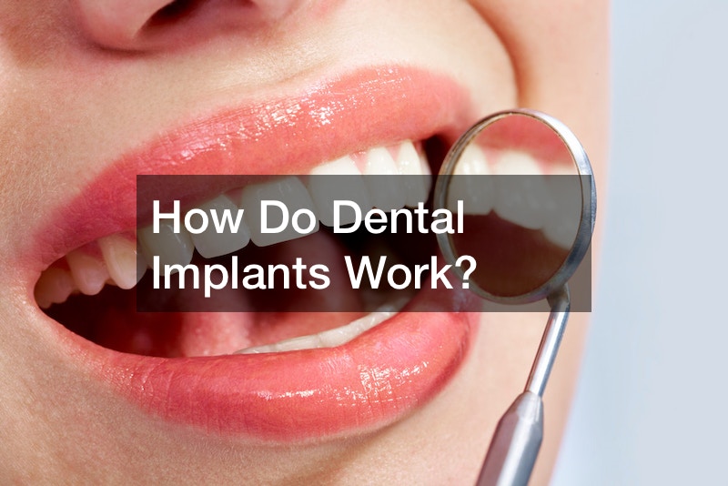 How Do Dental Implants Work?