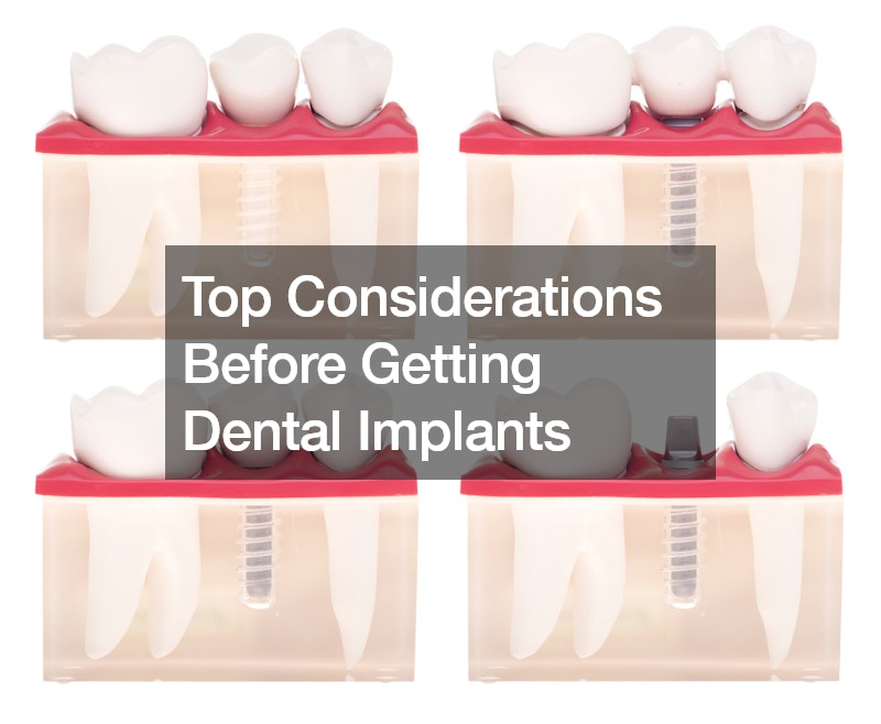 Top Considerations Before Getting Dental Implants